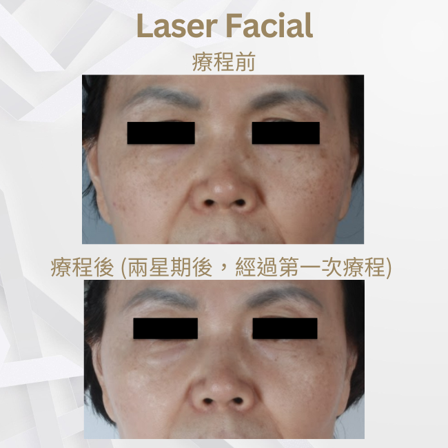 PicoPlus皮秒激光療程 - MPMED Aesthetic