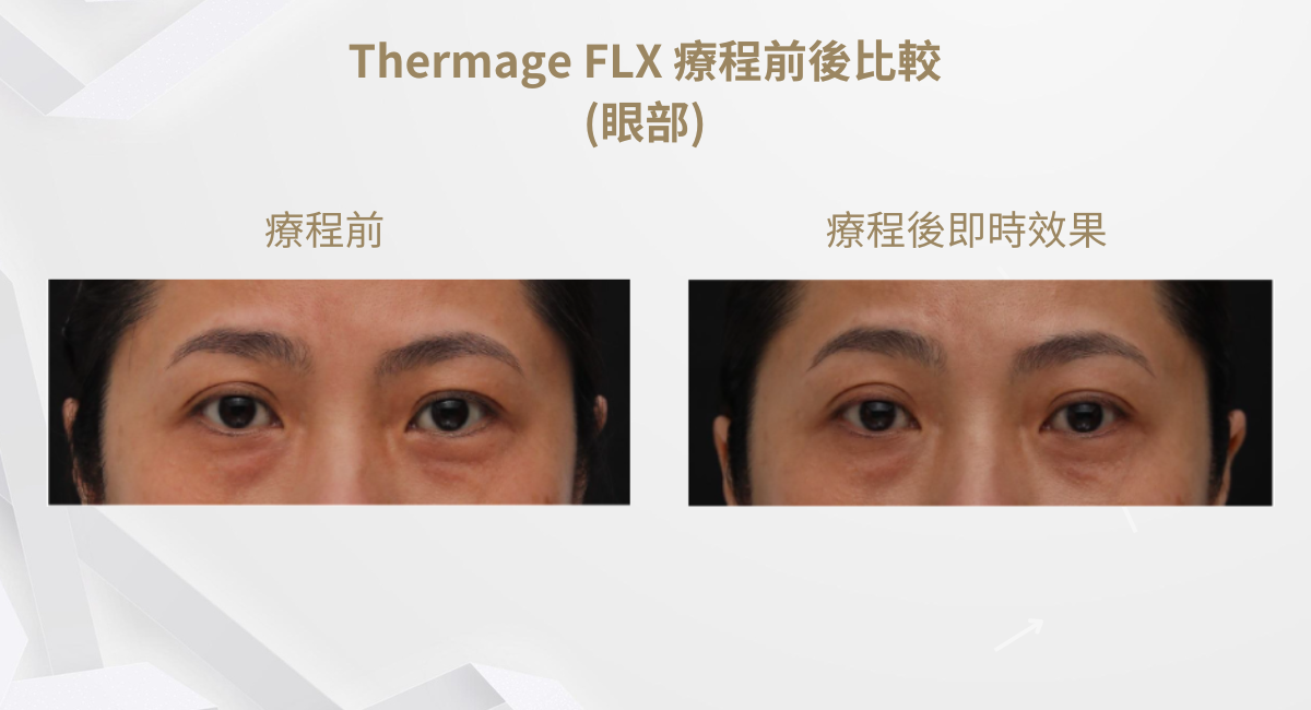 Thermage FLX 療程前後比較(眼部) 1