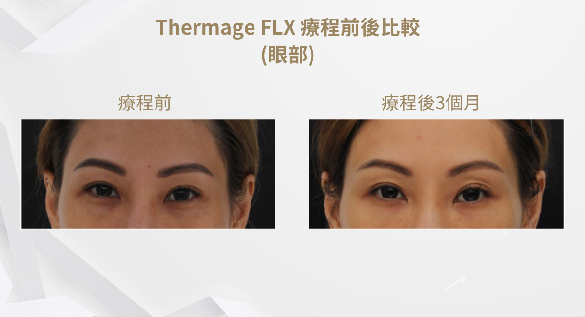 Thermage FLX 療程前後比較(眼部) 2