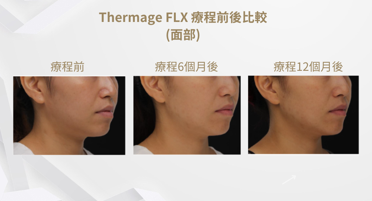 Thermage FLX 療程前後比較(面部)1