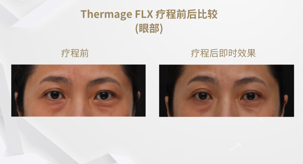 Thermage FLX 療程前後比較(眼部) 1
