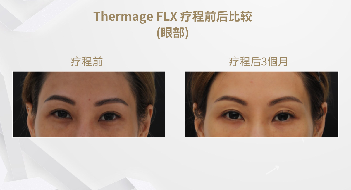 Thermage FLX 療程前後比較(眼部) 2