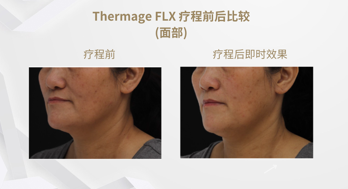Thermage FLX 療程前後比較(面部)2