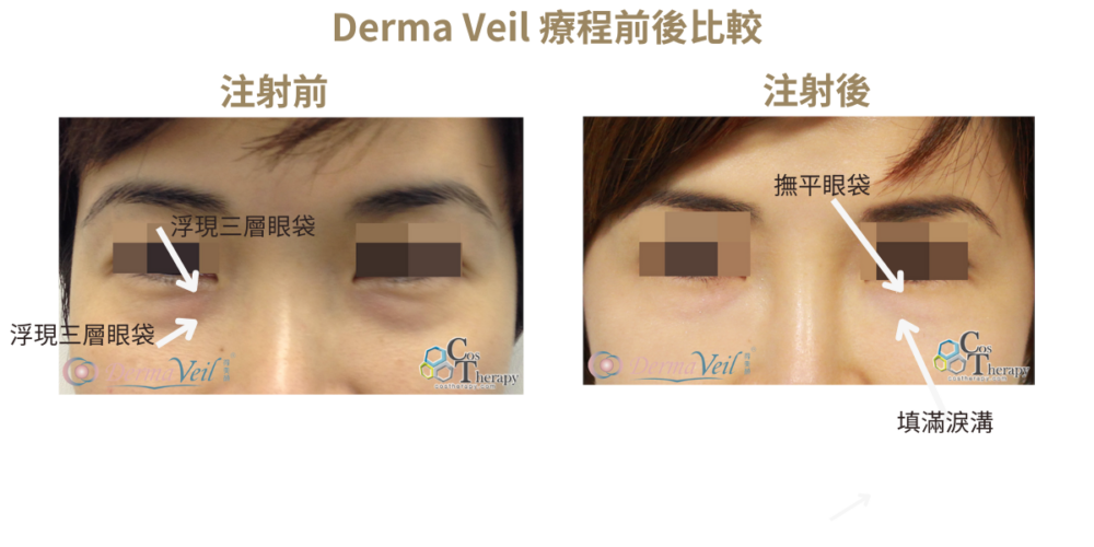 Derma Veil 療程前後比較 1