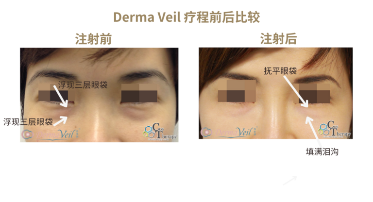 Derma Veil 療程前後比較 1-SC
