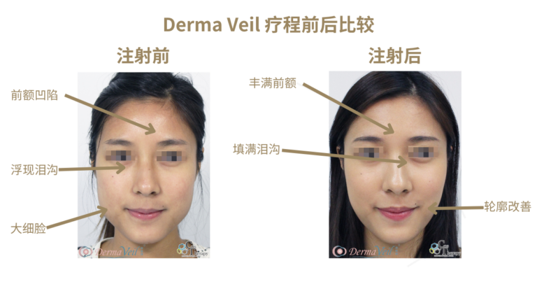 Derma Veil 療程前後比較 2-SC
