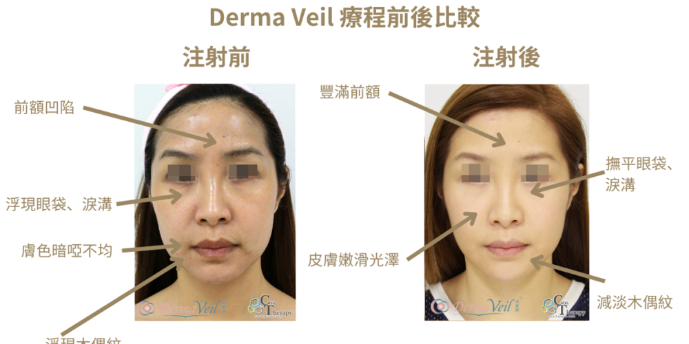 Derma Veil 療程前後比較 3