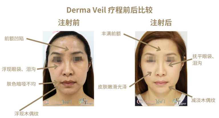 Derma Veil 療程前後比較 3-SC