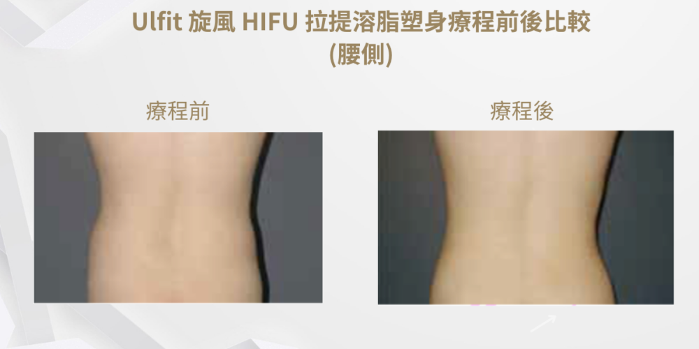 Ulfit 旋風 HiFU 拉提療程前後比較(腰側)1