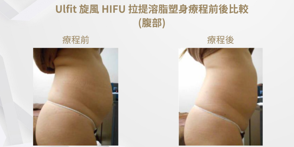 Ulfit 旋風 HiFU 拉提療程前後比較(腹部)2