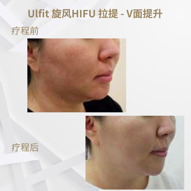 Ulfit 旋風HIFU 拉提 - V面提升_SC